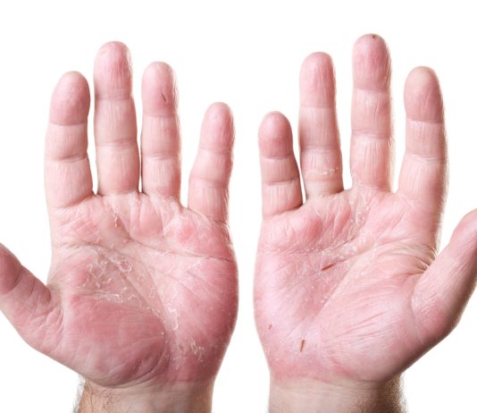 Hand Eczema Treatment
