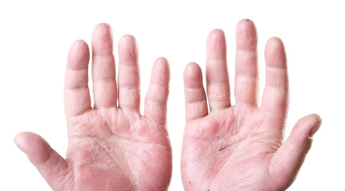 Hand Eczema Treatment
